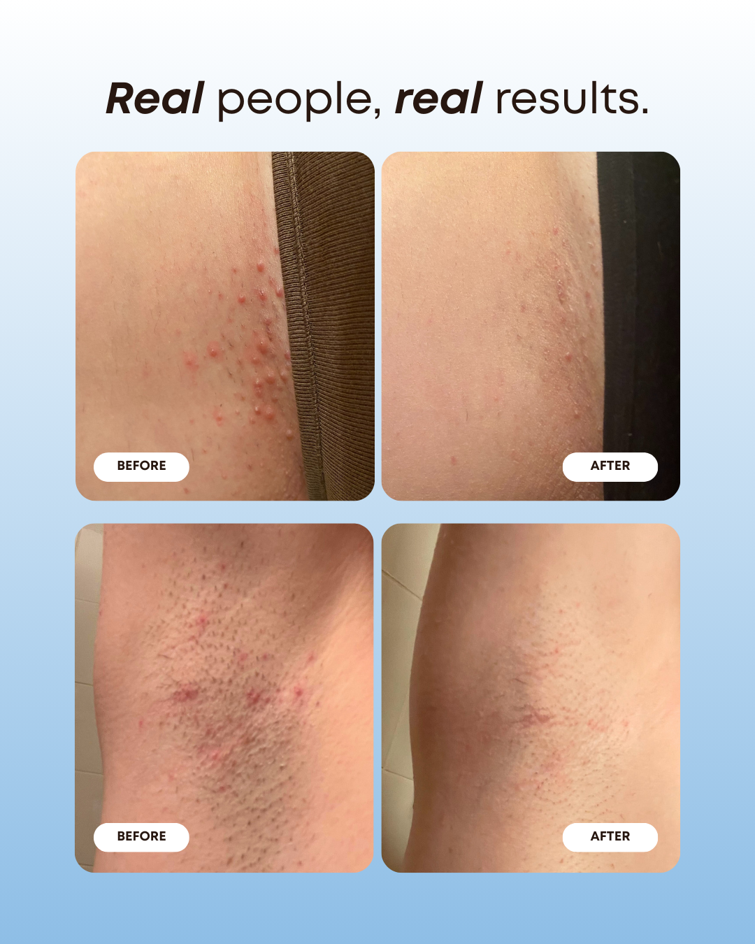 Ingrown Hair Oil- Mini Nude